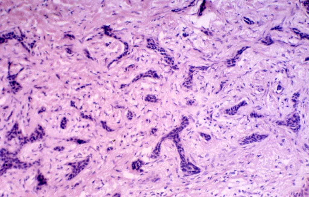 Basalioma (basal cell carcinoma)